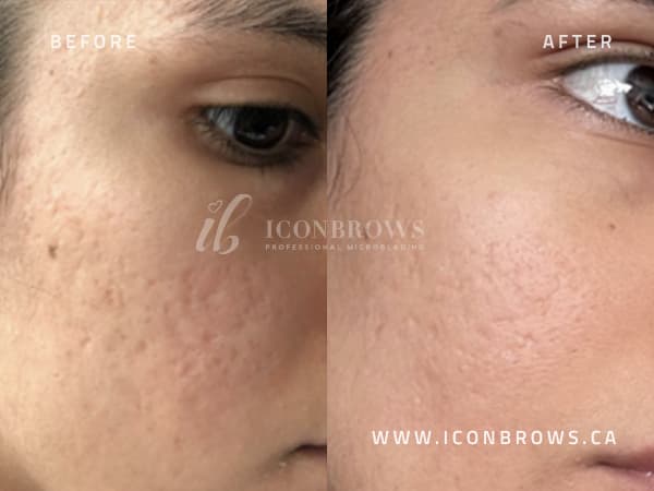 face treatments facial from iconbrows microneedling.